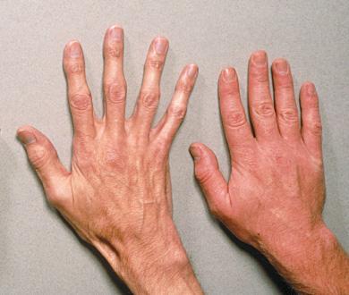Figure 3.20a The Hand on the Right Shows Normal Finger Growth.