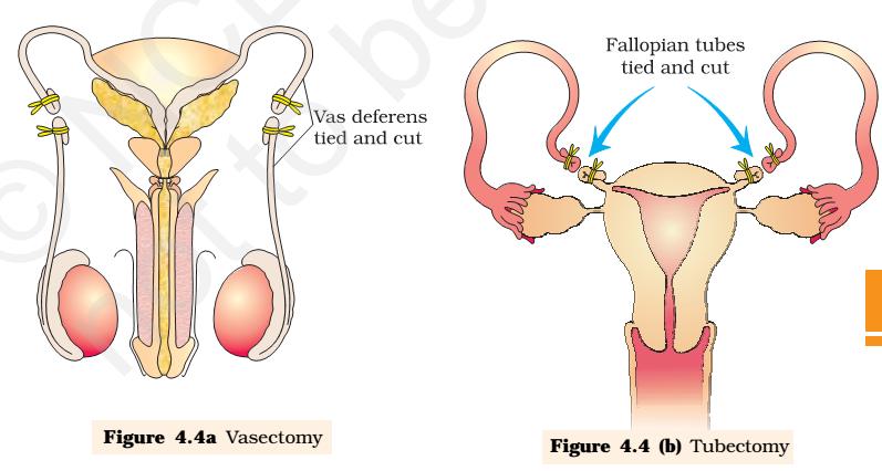 causes bizarre and irregular growth of the endometrium. Prevents implantation of a fertilized ovum.
