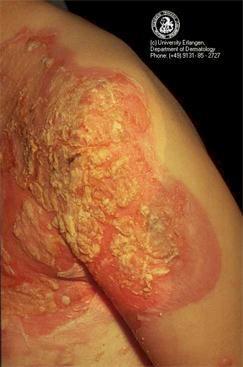 Bacterial infections: treatment and prevention 5 Localized infections surgically 90 % of