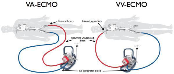 ECMO Các loại ECMO Hỗ trợ hô hấp : V-V Hỗ trợ