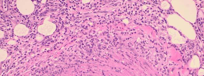 Genomic Biomarker Development Vasculitis Vasculitis is a major safety issue associated with a