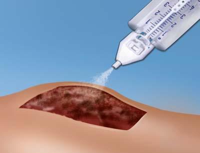 2 How ARTISS Works ARTISS is applied with a spray device to achieve an even and thin layer on the wound area 3,4,7 The wound surface should be as dry as possible before application.