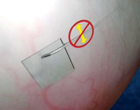 is prevented by the scleral tuck FIGURES