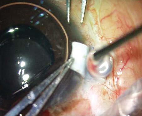 FIGURE 32: Haptic in the sclera pocket