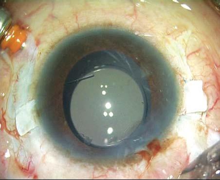 cut off and air fills the anterior chamber