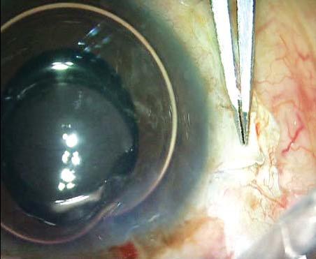 FIGURE 36: Scleral flap