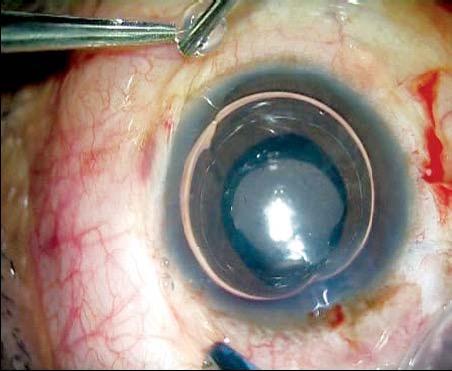 corneal incison to seal