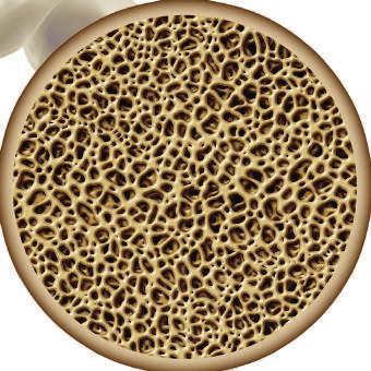Marrow Cellution Percutaneous Bone Graft Collection Produces Autologous Cancellous Graft Material with Osteoconductive, Osteoinductive & Osteogenic Properties Minimally Invasive Cancellous Bone Core