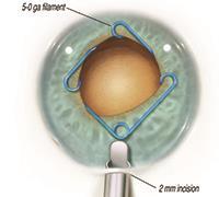 For example, a small pupil makes virtually every step of a cataract procedure more problematic.