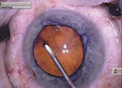 implantation. Not surprisingly, over the years surgeons have developed numerous techniques and devices that help to offset the problems created by a small pupil usually by temporarily enlarging it.