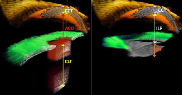 Full 3-D OCT biometry in cataract surgery Ortiz et al.