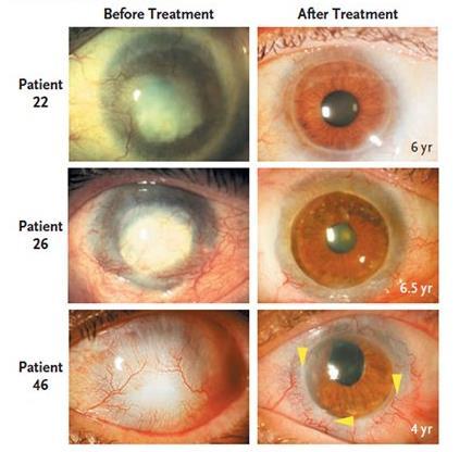 Treatment worked completely in 82 of 107 eyes.