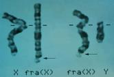 Genetic disorders of repeats Fragile X syndrome most common form of inherited mental retardation