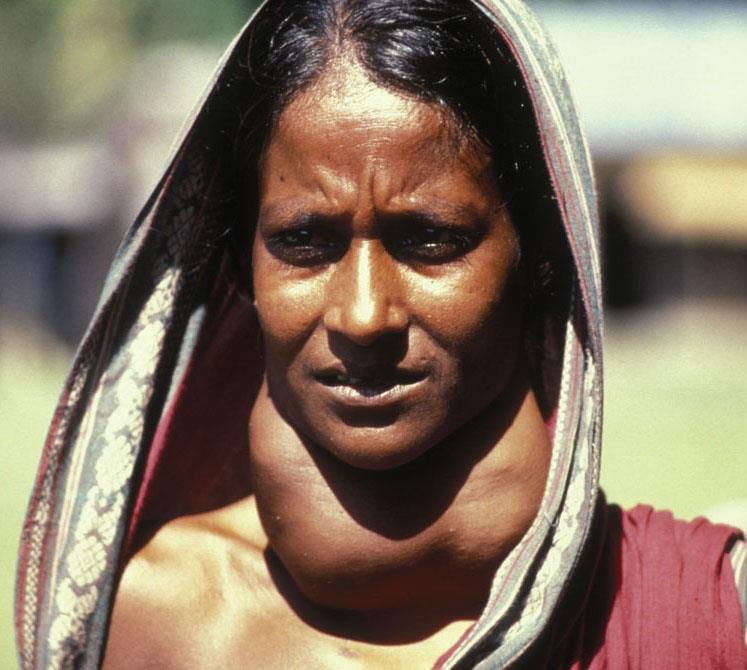 Woman with Goiter in Bangladesh: