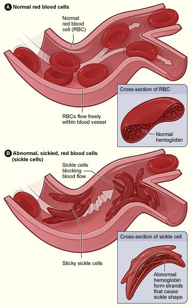 Sickle-Cell Disease: A Genetic Disorder with Evolutionary Implications Sickle-cell disease affects one out of 400 African-Americans 겸상적혈구빈혈증 (sickle-cell anemia) The disease is caused by the