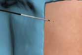 You can eliminate one or more trocars from your laparoscopic procedures while achieving the outcomes