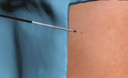 You can eliminate one or more trocars from your laparoscopic procedures while achieving the outcomes