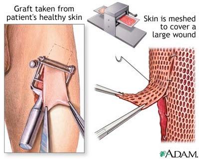 transplanted: Skin graps Involve skin stem
