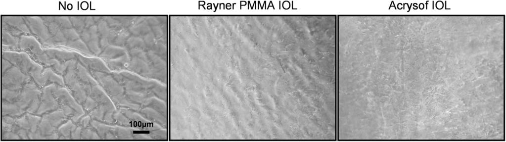 Rayner PMMA round-edge or an Alcon AcrySof acrylic IOL. 2; this combination is likely to arise in the local lens environment after surgery.