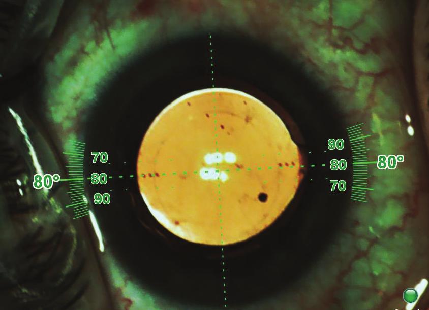 Note the 80º implantation axis. Figure 2B shows the same case during alignment mode, the final stage of image guidance with the VERION Image Guided System.
