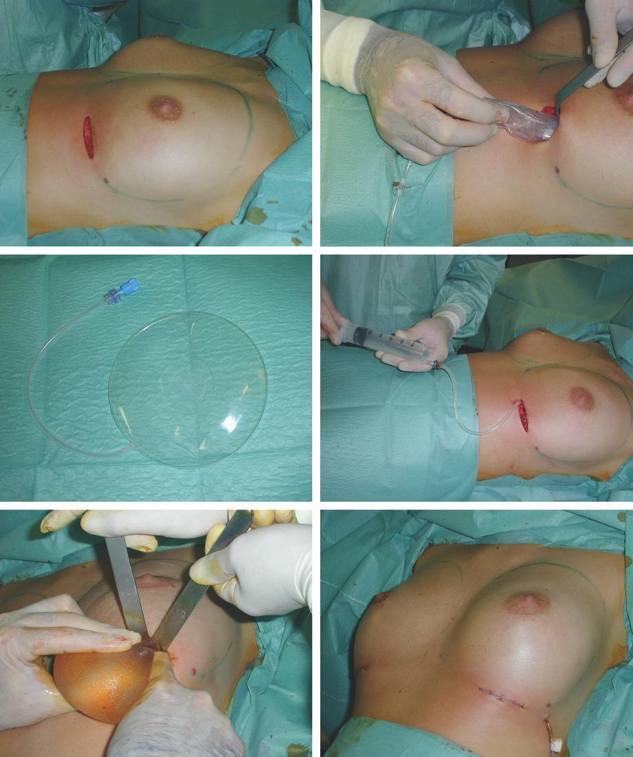 208 24 Intraoperative Assessment of Breast Prosthesis Volume Using a Set of Graduated Expanders Fig. 24.1 Intraoperative steps. a Inframammary incision. b Phantom introduction.