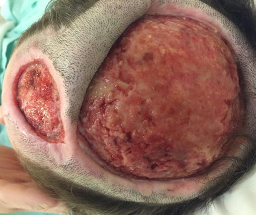 Case Study: Non-healing large scalp wound with