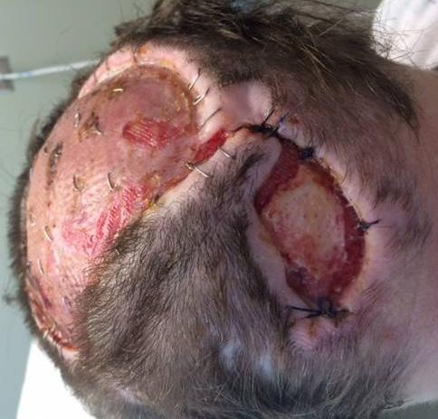 1cm sized scalp wound in a 39-year-old female