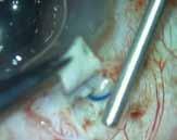 Excess length is trimmed, and the haptic is tucked into an oblique (coat hanger) intrascleral Scharioth tunnel 4 made at the edge of the scleral flap with a 26-gauge needle.