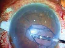 C Figure 4. (,) The dangling lens is brought up into the anterior chamber and emulsified using the IOL as a scaffold.