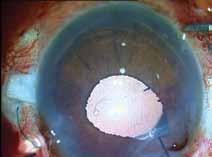 (D) The haptics are tucked into scleral tunnels and the flaps and conjunctiva are glued down using fibrin glue.