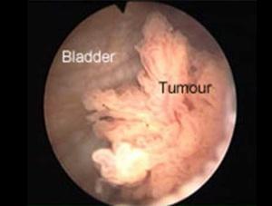 Previous Studies Male rats developed cancerous tumors in the bladder after intense exposure to cyclamate