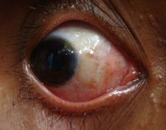 None of the patients had sub-conjunctival haemorrhage at 1 st, 3 rd and 6 th months postoperatively.