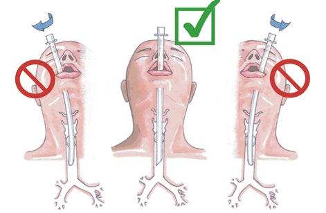 Intubate: 4 cm between ETT tip & carina are required for the