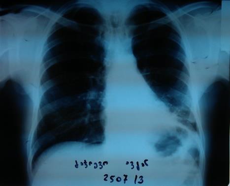 59 stentirebdan 3 Tvis Semdeg - astmis bronqoskopiuli mkurnaloba astmis bronqoskopiuli mkurnalobisaxali, medikamentozuri