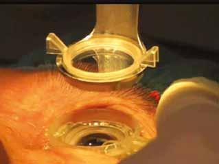 In this procedure, a noninvasive, computer-controlled, ultrashort pulse laser automatically performs the most difficult steps of cataract surgery namely capsulorrhexis, lens fragmentation, and