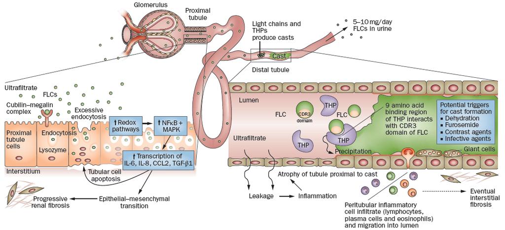 Renal failure in MM is linked to FLC toxicity AL Amyloidosis LCDD Cast Nephropathy Fanconi