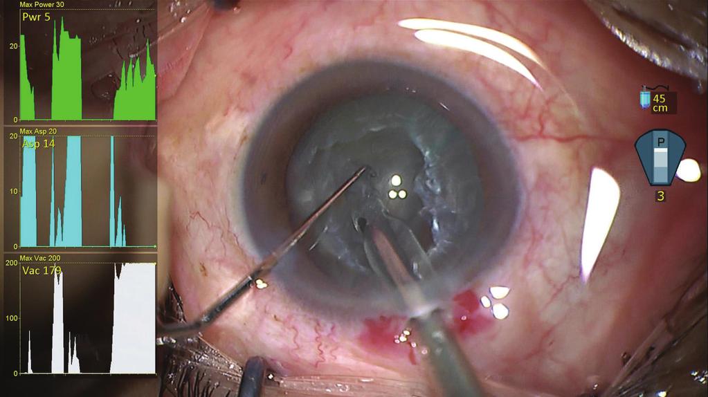 36 ± 29 mmhg/sec, respectively, for the 21st to 4th cataract surgeries (intermediate group) and were 1.5 ±.26 sec and 297±32 mmhg/sec for the 41st to 6th cataract surgeries (latter group).
