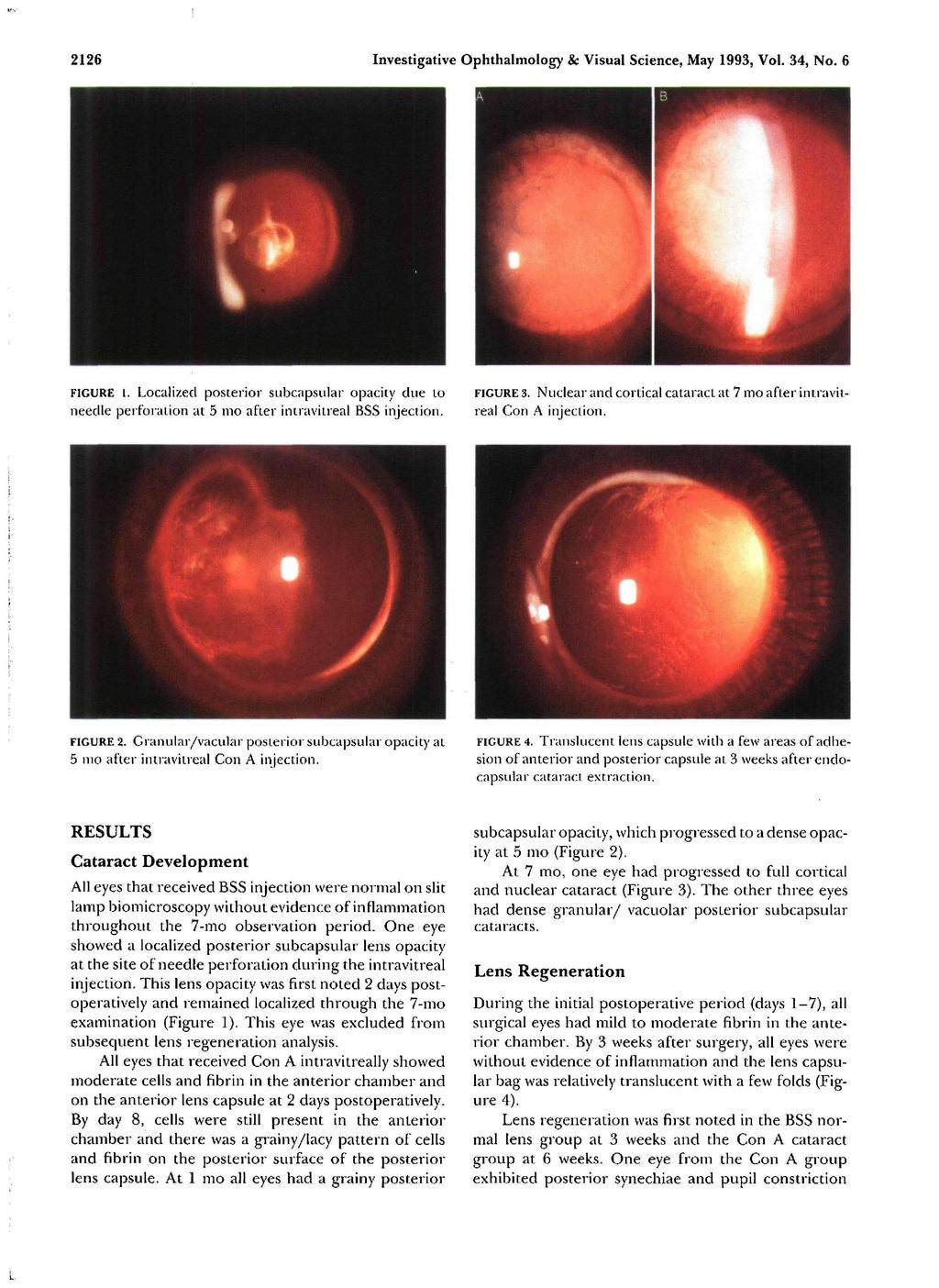2126 Investigative Ophthalmology & Visual Science, May 1993, Vol. 34, No. 6 FIGURE 1. Localized posterior subcapsular opacity due to needle perforation at 5 mo after intravitreal BSS injection.