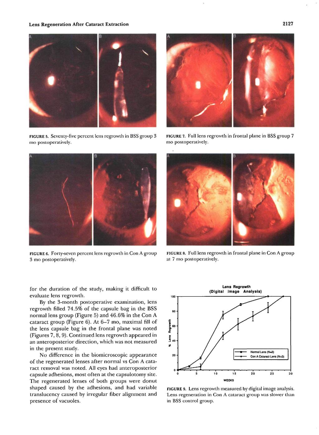 2127 Lens Regeneration After Cataract Extraction FIGURE 5. SevenLy-five percent lens regrowth in BSS group 3 mo postoperatively. FIGURE 7.