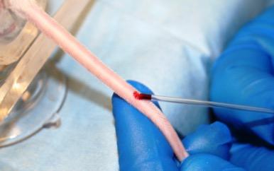 ii. Observe blood flash and allow blood to drip from needle hub into collection tube or into hematocrit tube via capillary