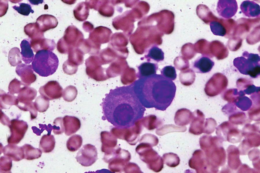 (c) Bone marrow aspiration smear showing atypical plasma cells (MayGiemsa stain x600).