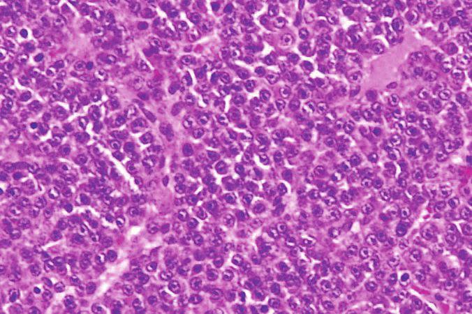 (d) Hematoxylin and eosin (H&E) stain showing diffuse infiltration of plasma cells.