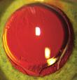 4% Plastics CUTTING-EDGE ADVANCEMENTS CATARACT & REFRACTIVE Capsular phimosis (anterior capsule opacification grade 4) in an eye implanted