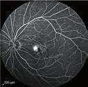 experience Clinical fi ndings and future considerations for a new generation IOL GLAUCOMA Combination drug-eluting lens Week-long IOP