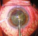 China may reduce injection frequency PAGE 24 15.8% Corneal/ External Eye Disease SEPTEMBER 2015 VOL. 11, NO.