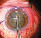 for dry eye disease Novel dexamethasone delivery system provides alternative to eye drops RETINA Europe surgeons switching to pars plana