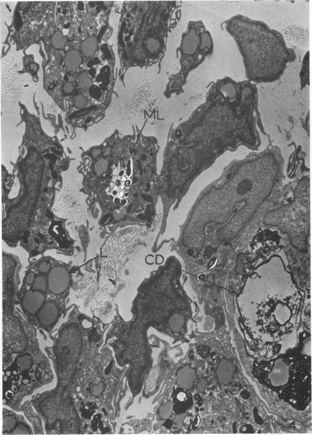 VOL.7, 1973 RESPONSE OF FOOT PAD TO M. LEPRAE 81 a- V.1, F.1 / I 'U i.,3 /.<.rs *\s W tb' ^^ FIG. 4. Electron micrograph of a cellular infiltrate showing cells containing phagocytized M.