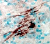 Parkinson s Huntington s Astrocytes Lysosomal Storage Diseases Oligodendrocytes