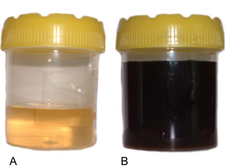 Garrod s Hypothesis Alcaptonuria: urine turns black when exposed to air an inherited disease a defective inheritance factor