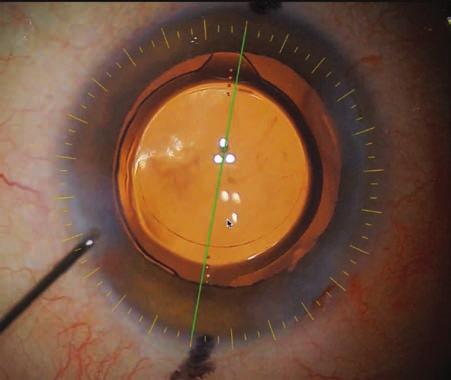 Cataract surgery and lens implantation Date Name Eye Birth Doctor position Steep axix: 149 Implantation axix: 150 Limbus: φ11.6mm Pupil: φ3.0mm Bottom Main incision: 181 181 Astigmatism axis: -0.95.